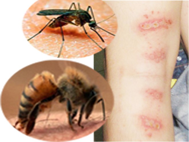 Cách giảm sưng, ngứa khi bị kiến/bọ đốt